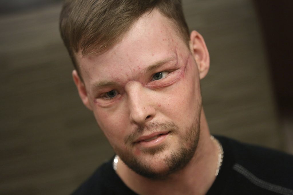Andy Sandness tiene un nuevo rostro después del exitoso trasplante