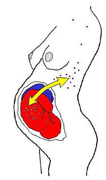 Microquimerismo fetomaternal
