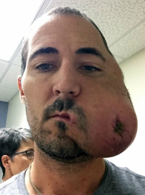 cirujano plástico, tumor, cirugía, cáncer, selfie, implante