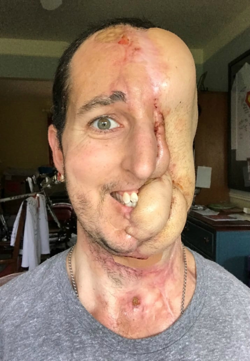 cirujano plástico, tumor, cirugía, cáncer, selfie, implante