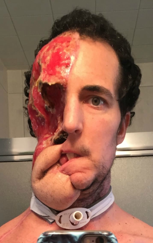 cirujano plástico, tumor, cirugía, cáncer, selfie, implante