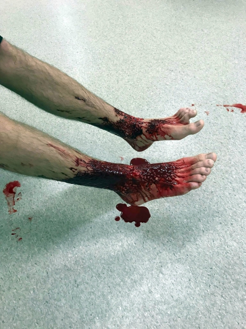 Carne, Piojos, Marinos, Pies, Sangre, Australia