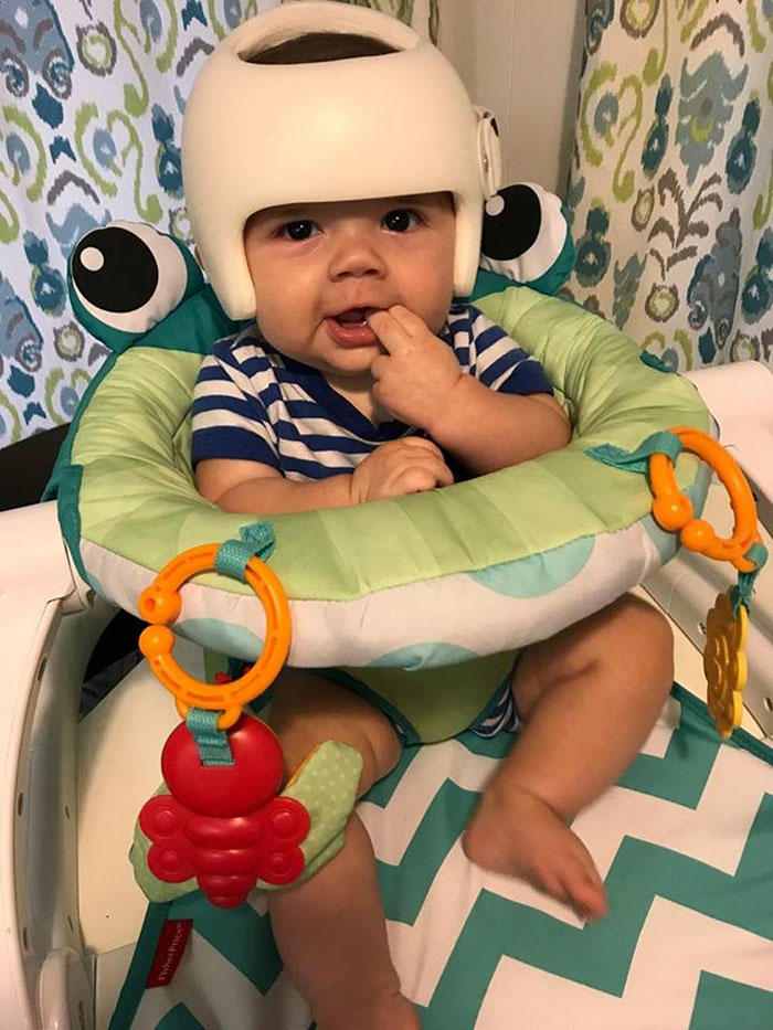 Junas Gutierrez, bebé con casco para tratar plagiocefalia