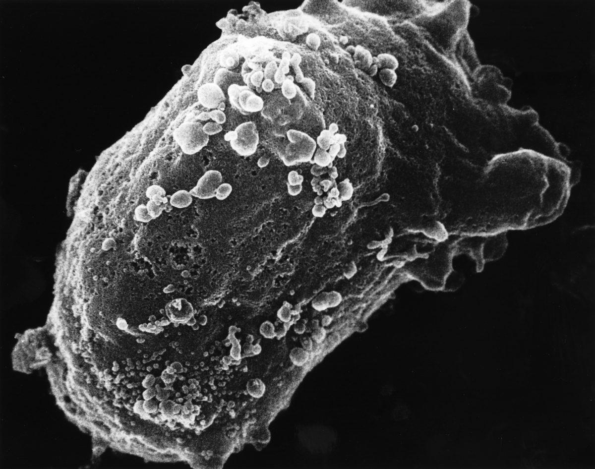 Limfocito infestado del virus del VIH