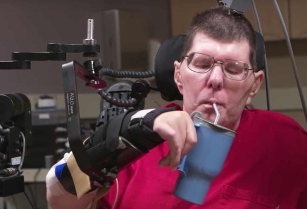 Bill Kochevar es el primer hombre con parálisis en comer con ayuda de implantes cerebrales