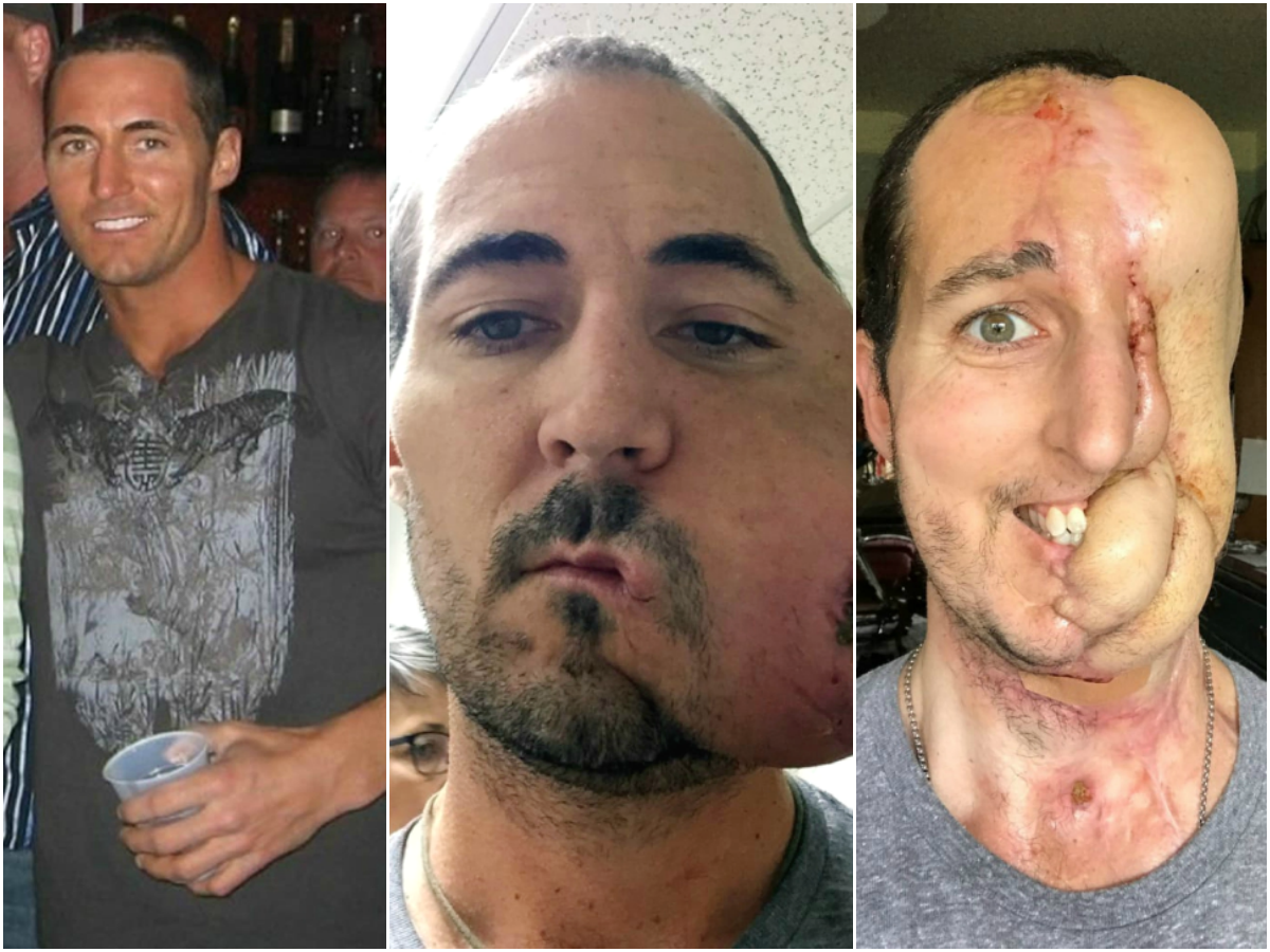cirujano plástico, tumor, cirugía, cáncer, selfie, implante