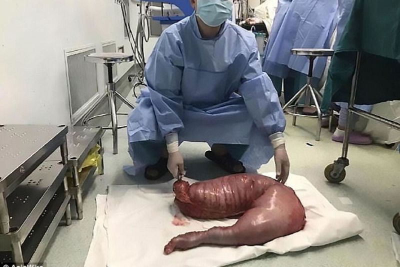 El colón de Zhou Hai, quien padece la enfermedad de Hirschsprung