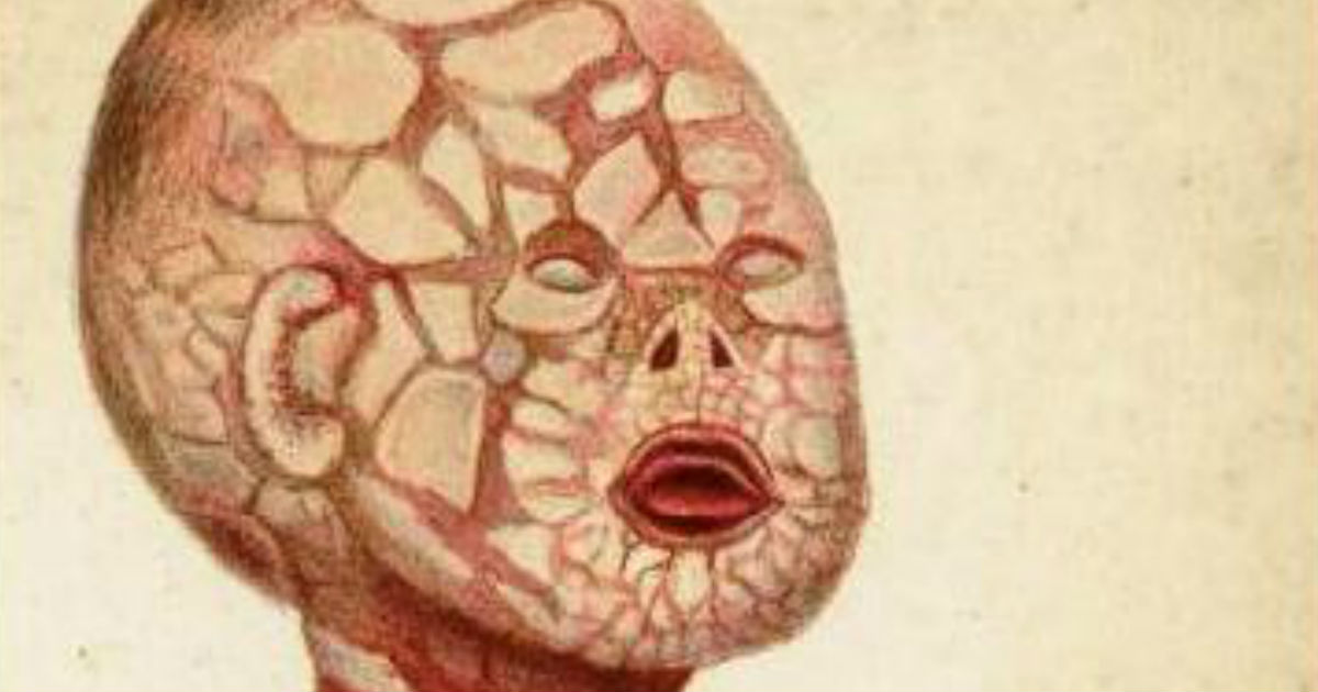ilustración-ictiosis-arlequin-bebe-feto-afectado-enfermedad