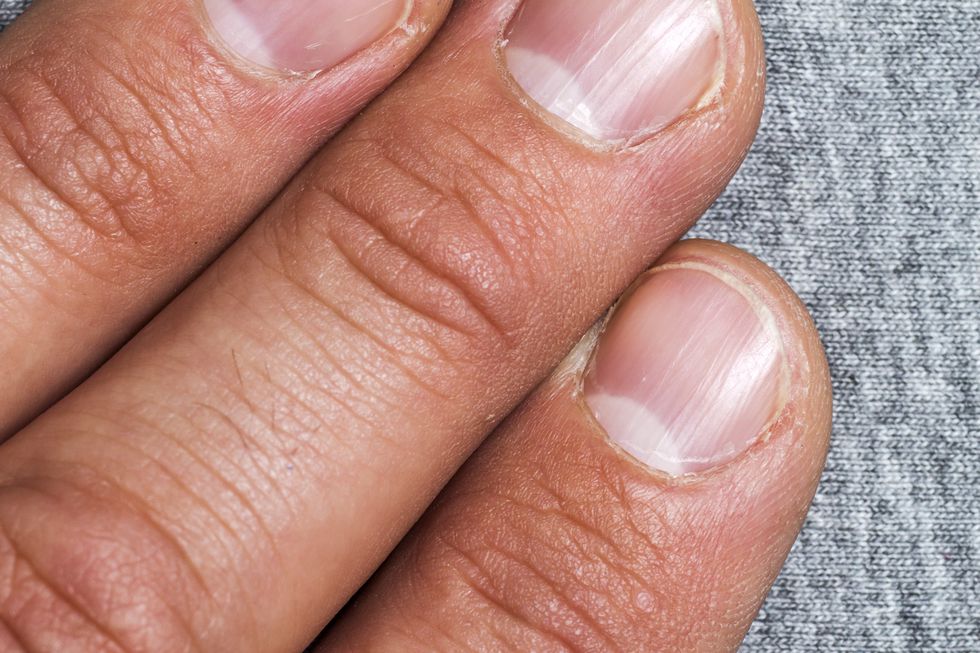 Persona Casi Muere Morderse Uñas Hospital