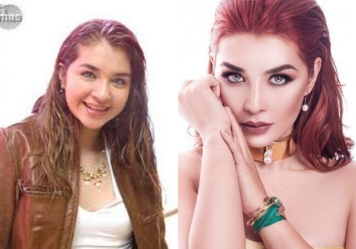 Mexicanas Cirugia Plastica