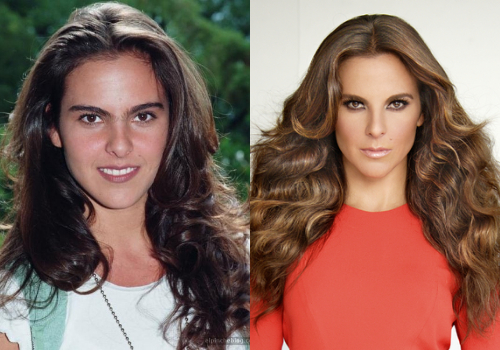 Famosas Antes y después cirugía plástica