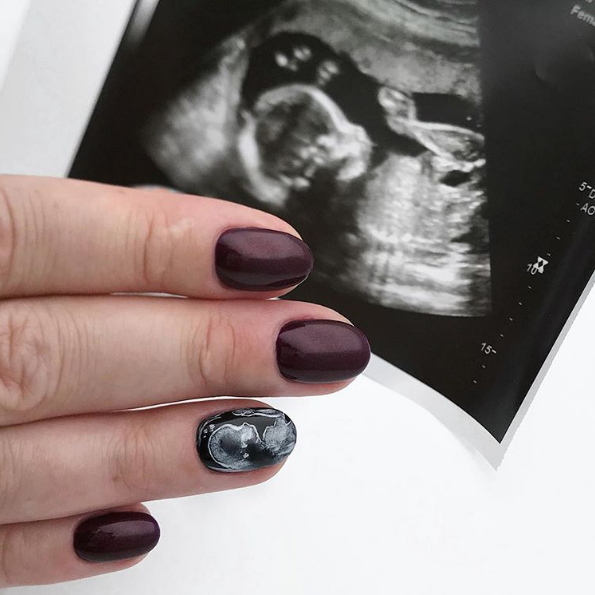 Uñas ultrasonido
