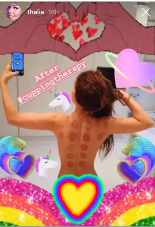 ThalÃ­a sube fotos desnudas con su cupping therapy