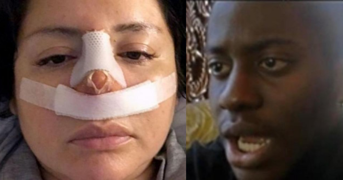 Fue a hacerse una lipo y el doctor le cambiÃ³ la nariz haciÃ©ndole "un favor"