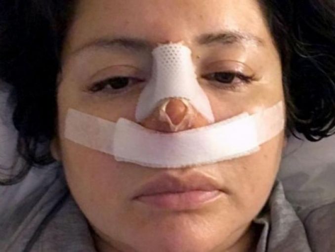 Mujer acudiÃ³ por liposucciÃ³n y le operaron la nariz