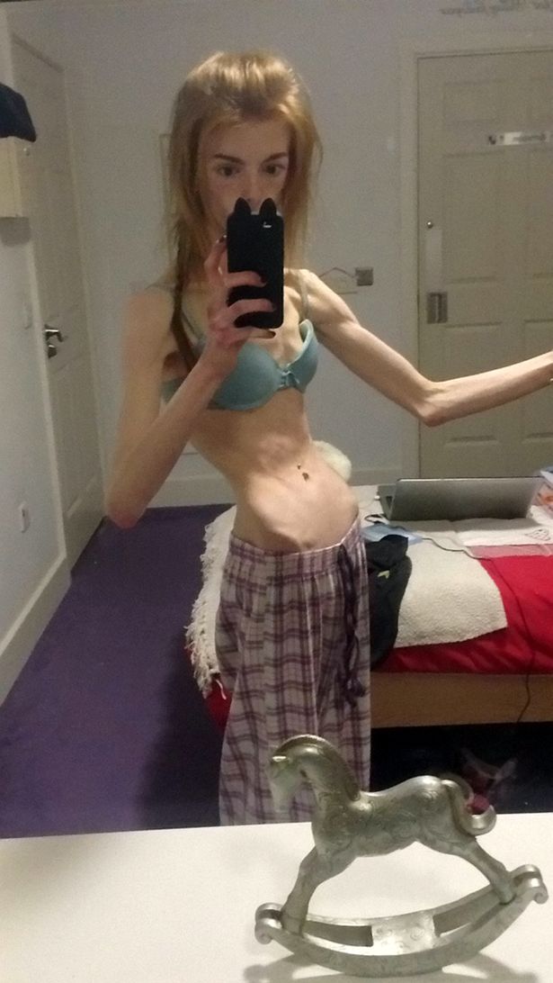 Annie Windley sobreviviÃ³ a la anorexia comiendo chocolate
