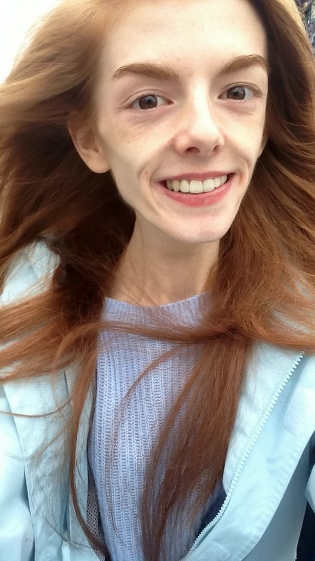 Annie Windley sobreviviÃ³ a la anorexia comiendo chocolate