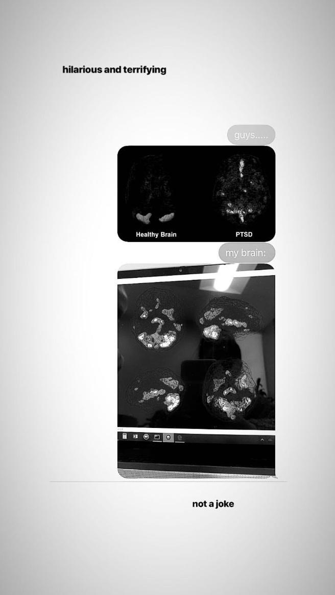 Ariana Grande: fotos de daño cerebral que sufre d Manchester