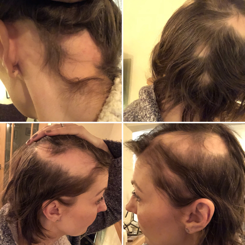 Mujer perdió el cabello por estres provocado por su boda