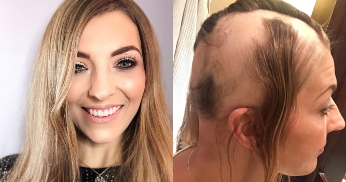 Novia Pierde Cabello EstrÃ©s Boda, Novia Desarrolla Alopecia Por EstrÃ©s Por Su Boda, Novia, Pierde Cabello, EstrÃ©s Boda, Alopecia