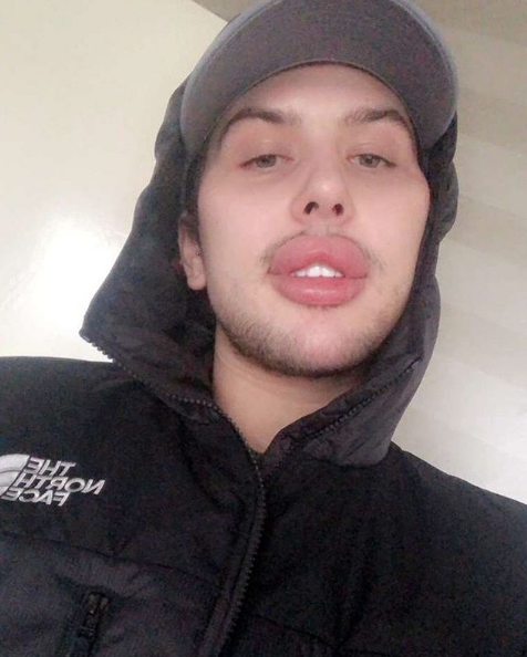 La historia del joven que aumentó el tamaño de sus labios