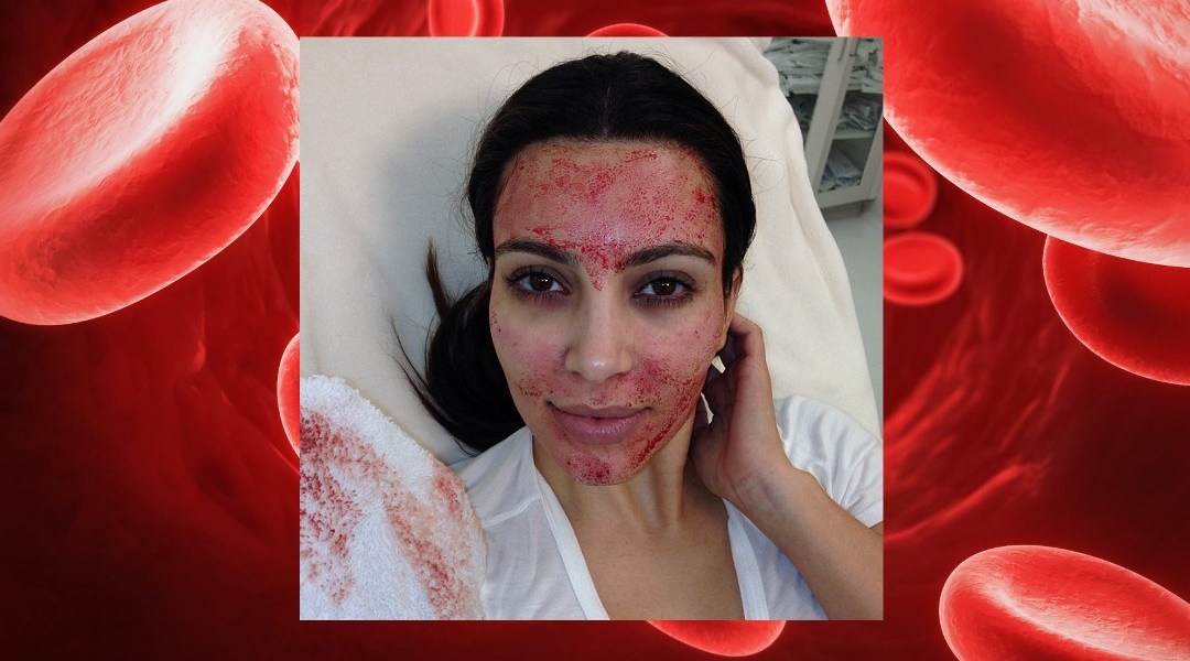 Spa contagió mujeres de VIH por tratamiento con sangre