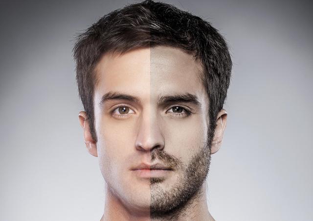 Los transplantes de barba nueva tendencia en Pr
