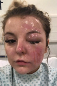 Mujer queda ciega por cocinar huevo en el microondas