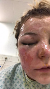 Mujer queda ciega por cocinar huevo en el microondas