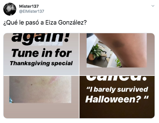 Eiza González publica fotos con moretones en el cuerpo