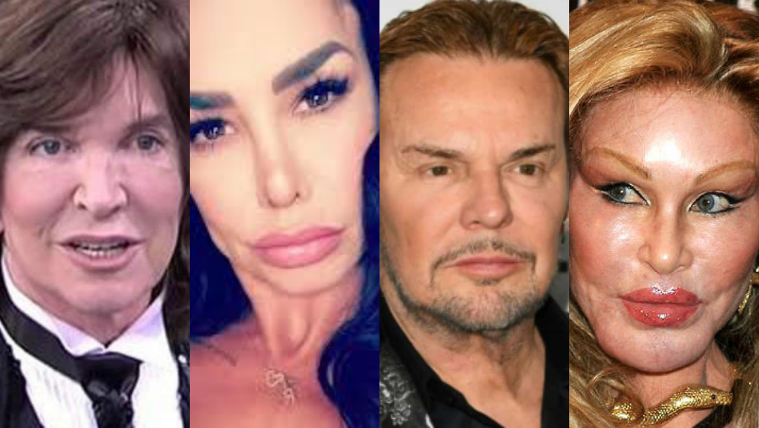 11 famosos cuyas cirugías plásticas salieron peor que ninguna otra
