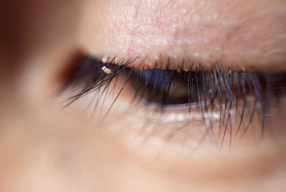 Alertan por piojos en extensiones para pestañas