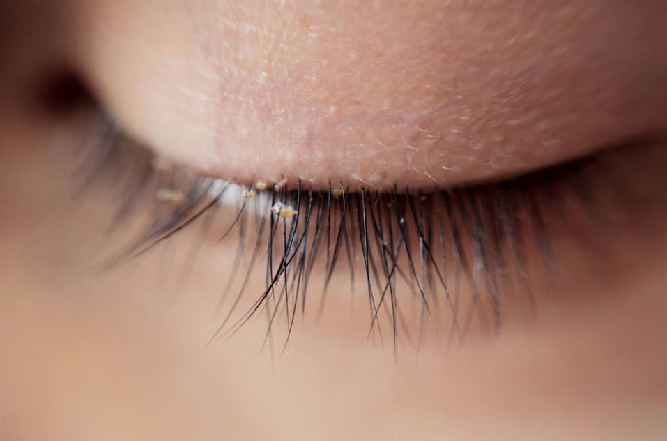 Alertan por piojos en extensiones para pestañas