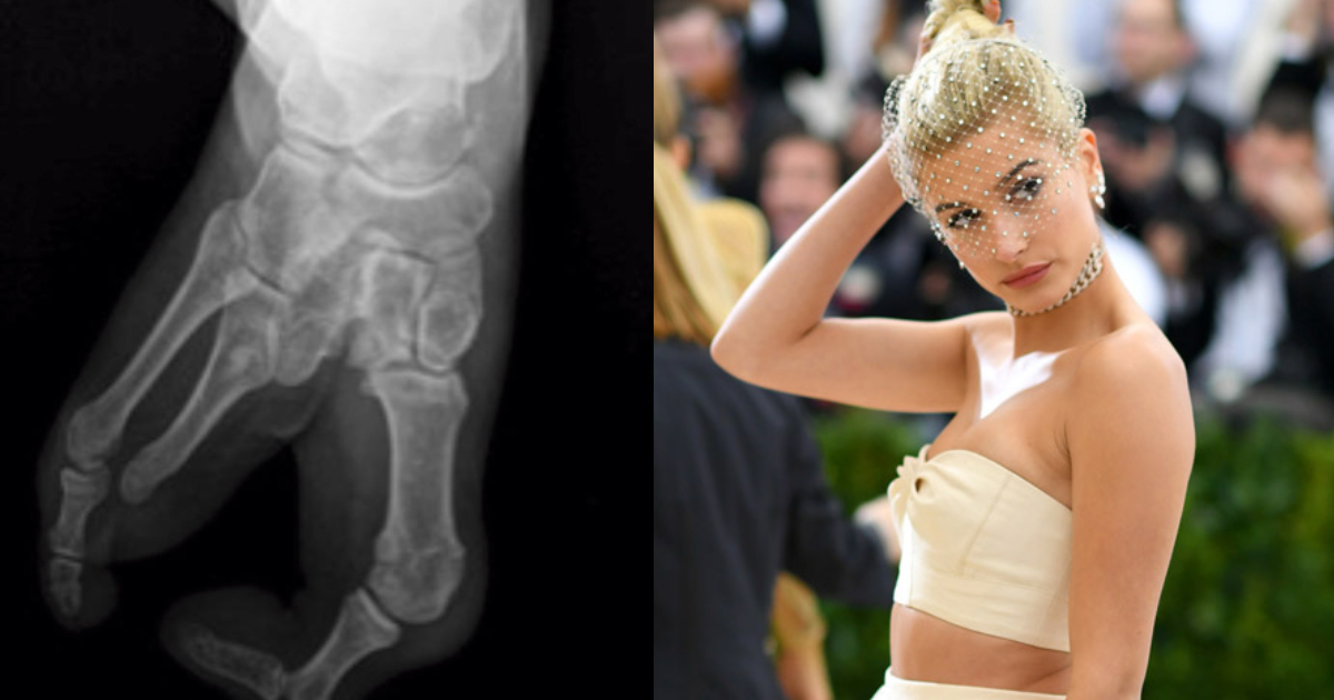 Hailey Baldwin revela cuál es la rara enfermedad que padece