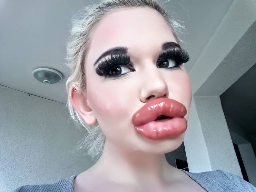 Barbie Humana aumenta el tamaño de sus labios por vigésima ocasion