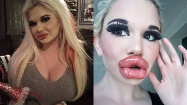 Barbie Humana operada tener labios mÃ¡s grandes del mundo