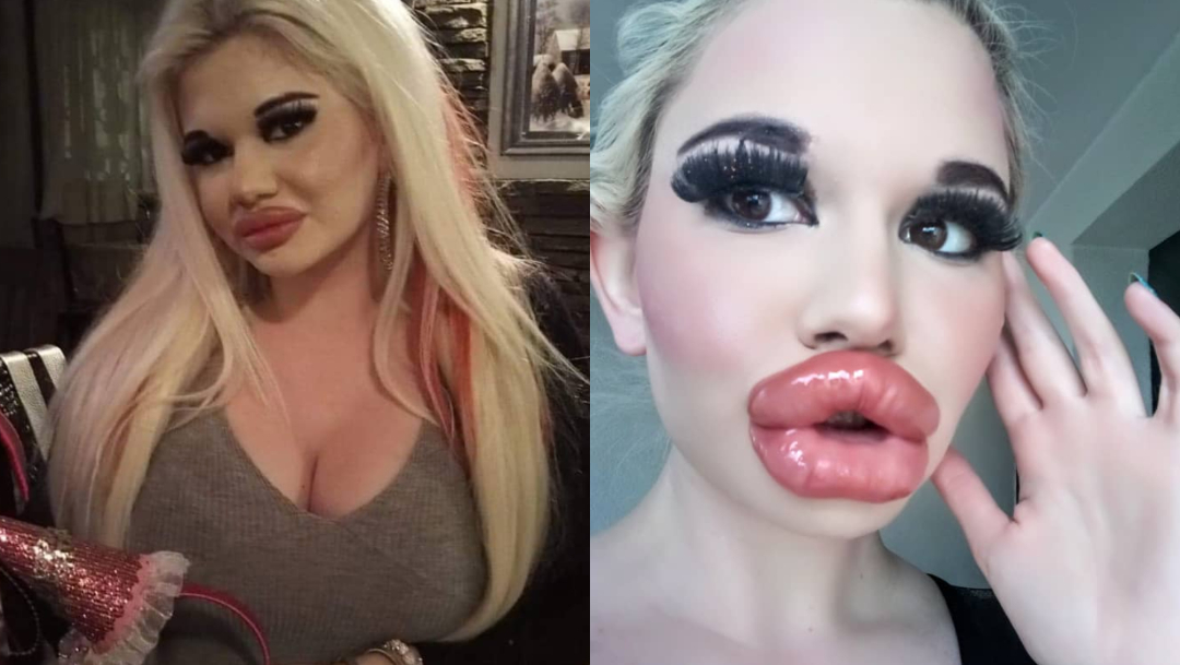 Barbie Humana operada tener labios más grandes del mundo