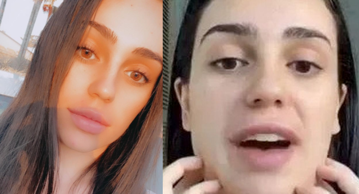 TikTok: influencer fracasa con tratamiento de reducir papada