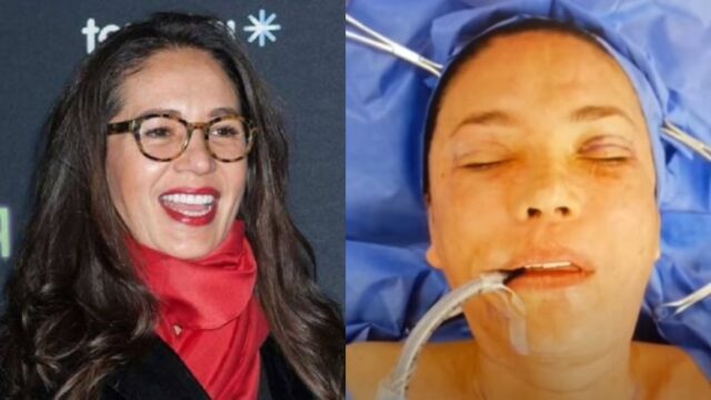Yolanda Andrade dio los detalles de sus cirugías en la cara