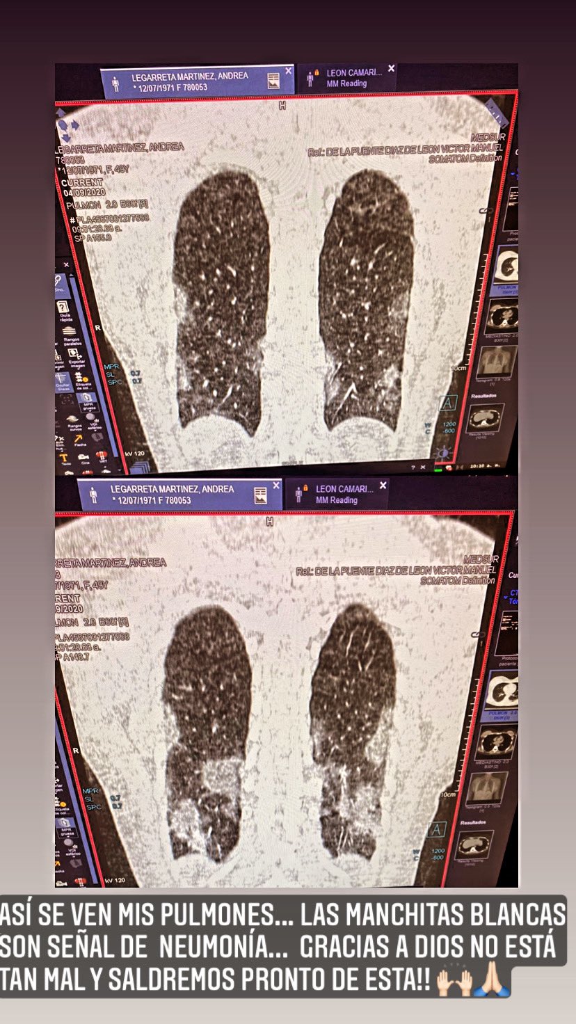 Andrea Legarreta muestra el daño en sus pulmones por la Covid-19