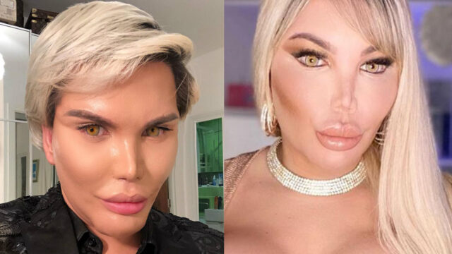 Barbie Humana rompe el silencio sobre los peligros de las cirugÃ­as luego de perder la nariz