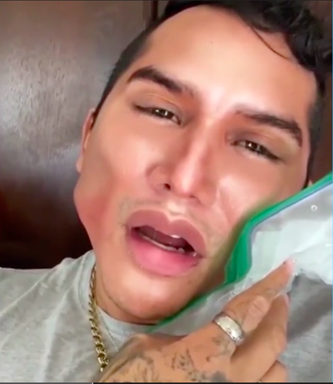 Edwin Luna aparece en redes sociales con una "mala cirugía"