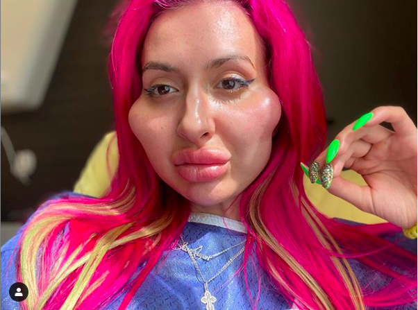 Conoce a la modelo de Instagram con las mejillas más grandes del mundo