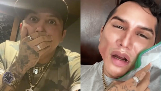 Edwin Luna aparece en redes sociales con una "mala cirugía"