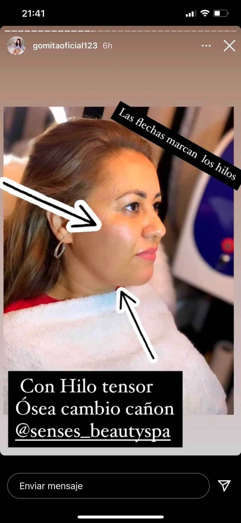 Madre de Gomita después de los arreglitos en el rostro