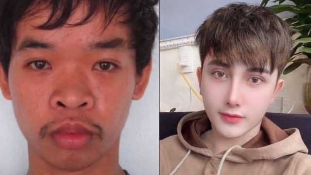 Do Quyen cirugias antes despues