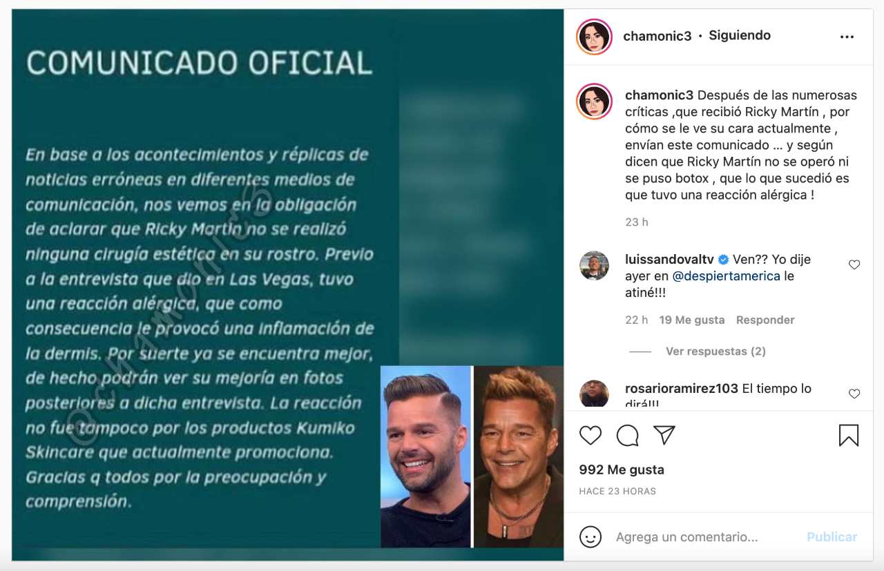 Aclaran rostro hinchado Ricky Martin comunicado