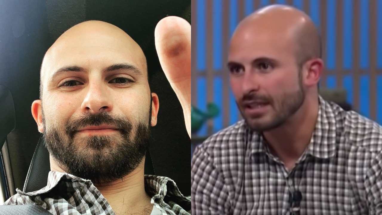 Imanol habla de su calvicie
