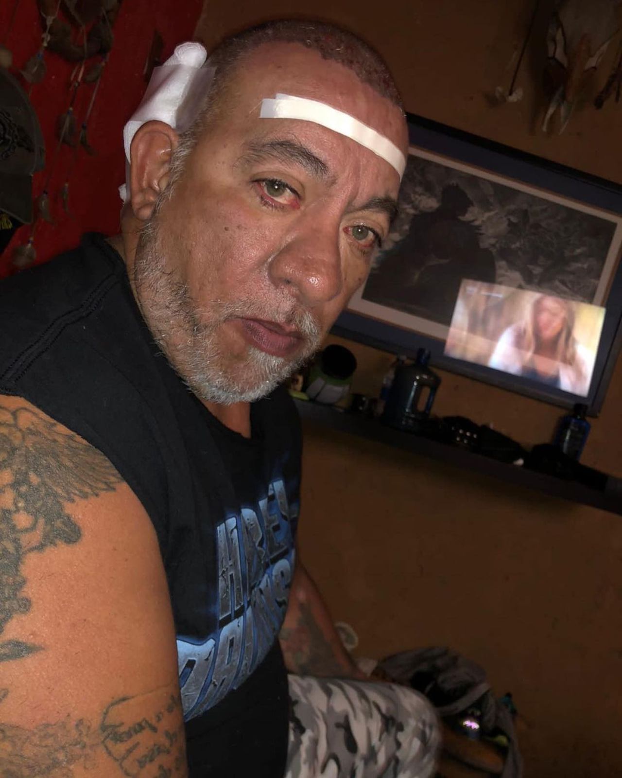 Carlos Trejo injerto cabello
