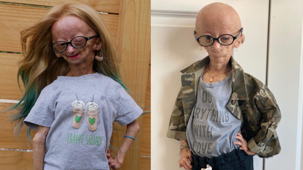 Adalia Rose Williams muere 15 anos